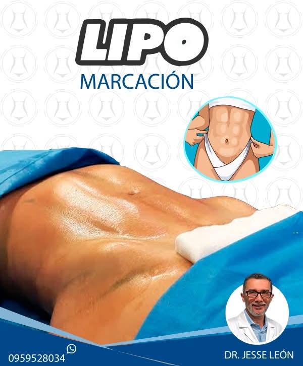 Lipo marcación de abdomen