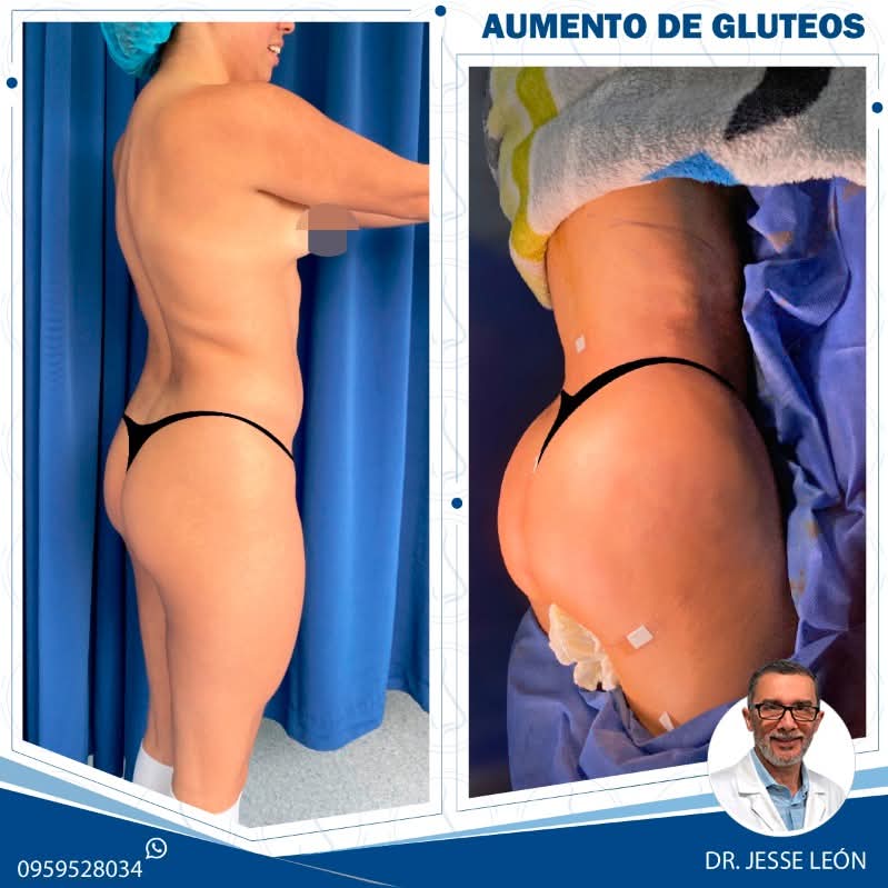 Aumento de glúteos antes y después