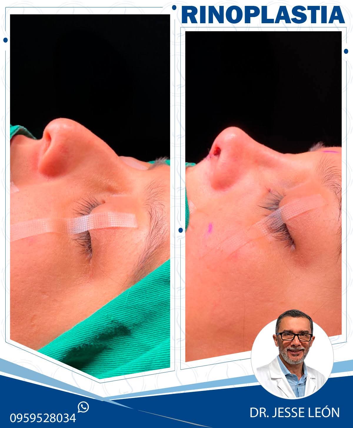 Rinoplastia antes y después